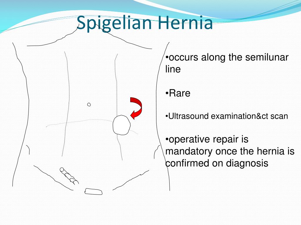 Spigelian Hernia Mayo Clinic Spigelian Hernia WVPOX