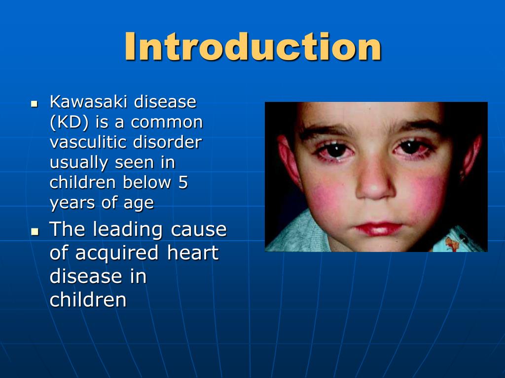 kawasaki disease slide presentation