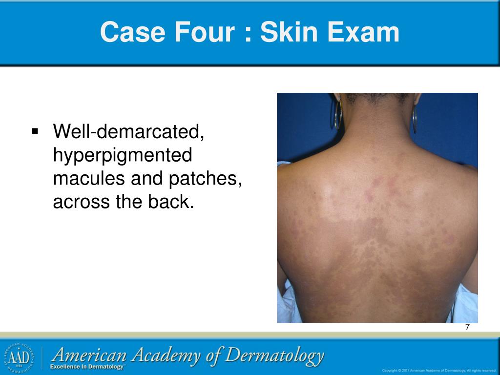 Skin Rash Exam PPT - Adult Cutaneous Fungal Infections 2: Yeasts PowerPoint ...