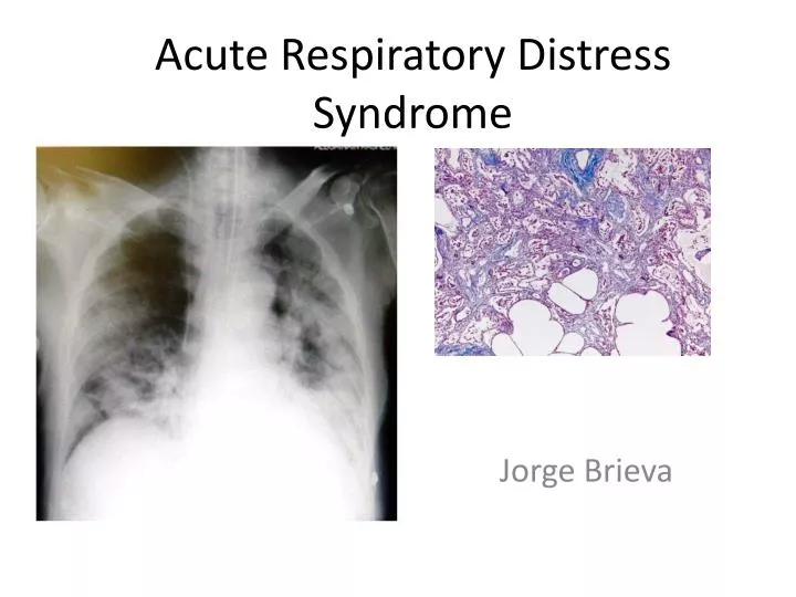 respiratory ards Special communication online first acute respiratory distress syndrome the berlin definition the ards definition task forcev alid and reliable defini. respiratory ards Special communication online first acute respiratory distress syndrome the berlin definition the ards definition task forcev alid and reliable defini.