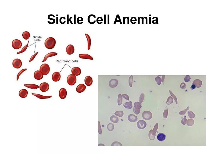 ppt-sickle-cell-anemia-powerpoint-presentation-free-download-id