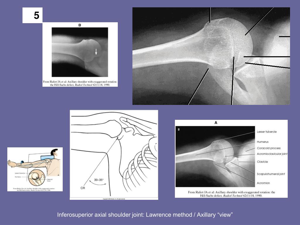 inferosuperior axial shoulder joint lawrence method axillary view.