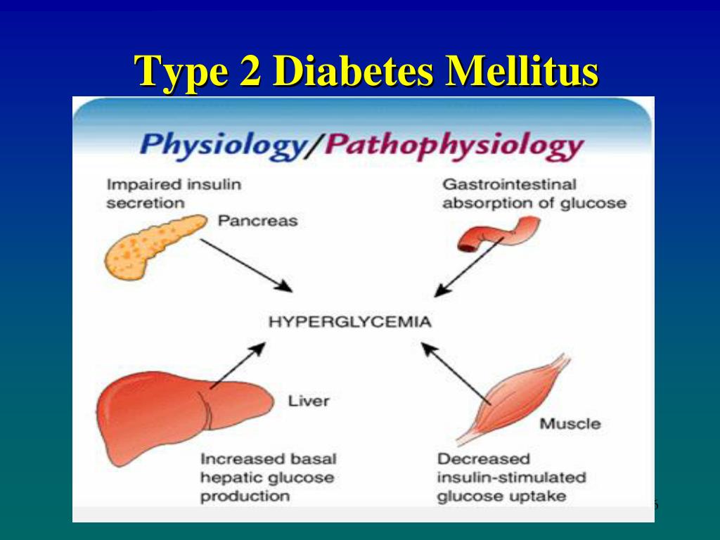 classic presentation of diabetes mellitus type 2
