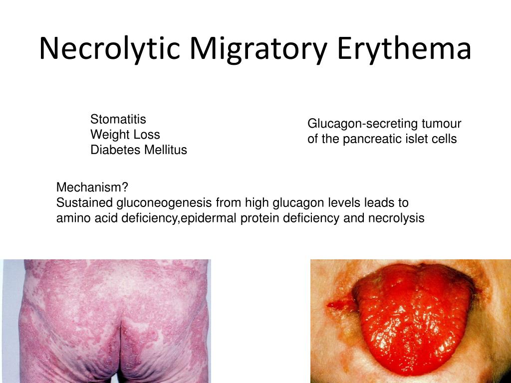PPT - Cutaneous Manifestations of Diabetes Mellitus PowerPoint ...