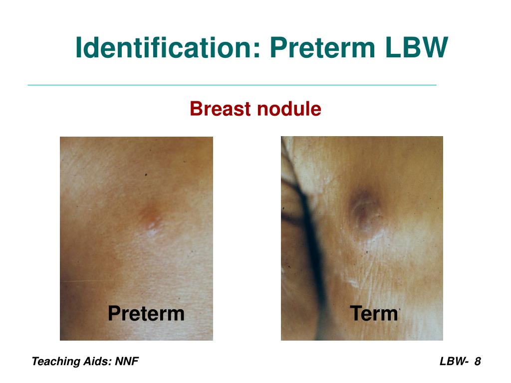 PPT Management of Low Birth Weight Babies PowerPoint Presentation