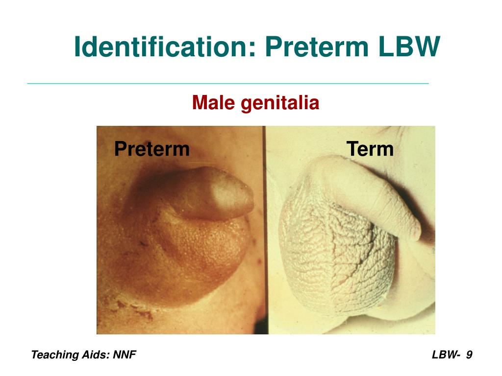 PPT Management of Low Birth Weight Babies PowerPoint Presentation