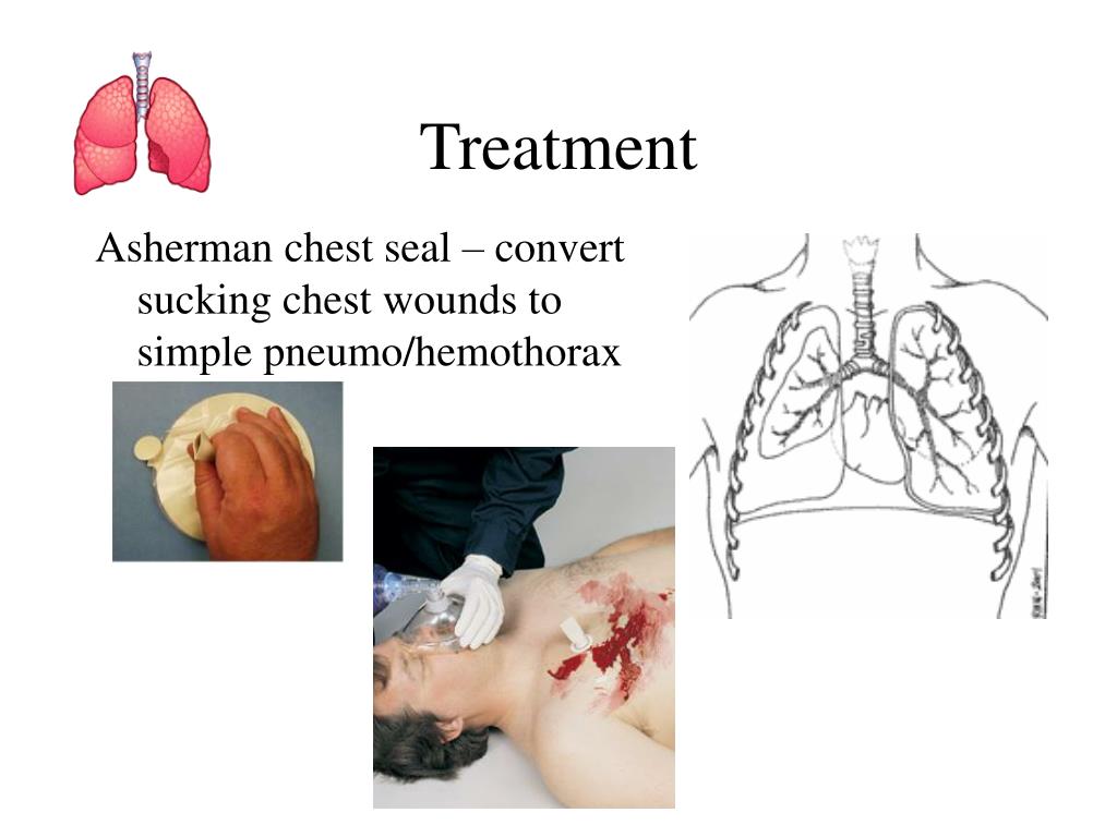 Asherman chest seal - convert sucking chest wounds to simple pneumo/hemotho...