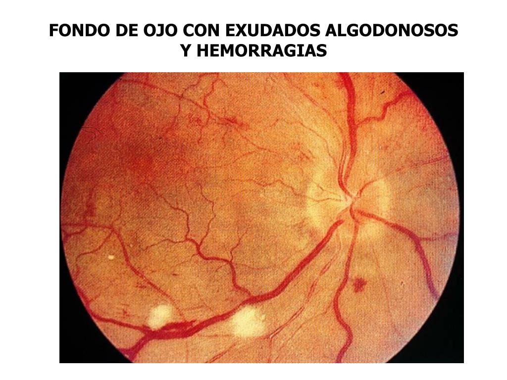 PPT IMPORTANCIA DE LA MICROCIRCULACI N RETINIANA EN LA EVALUACI N DEL ppt-importancia-de-la-microcirculaci-n-retiniana-en-la-evaluaci-n-del