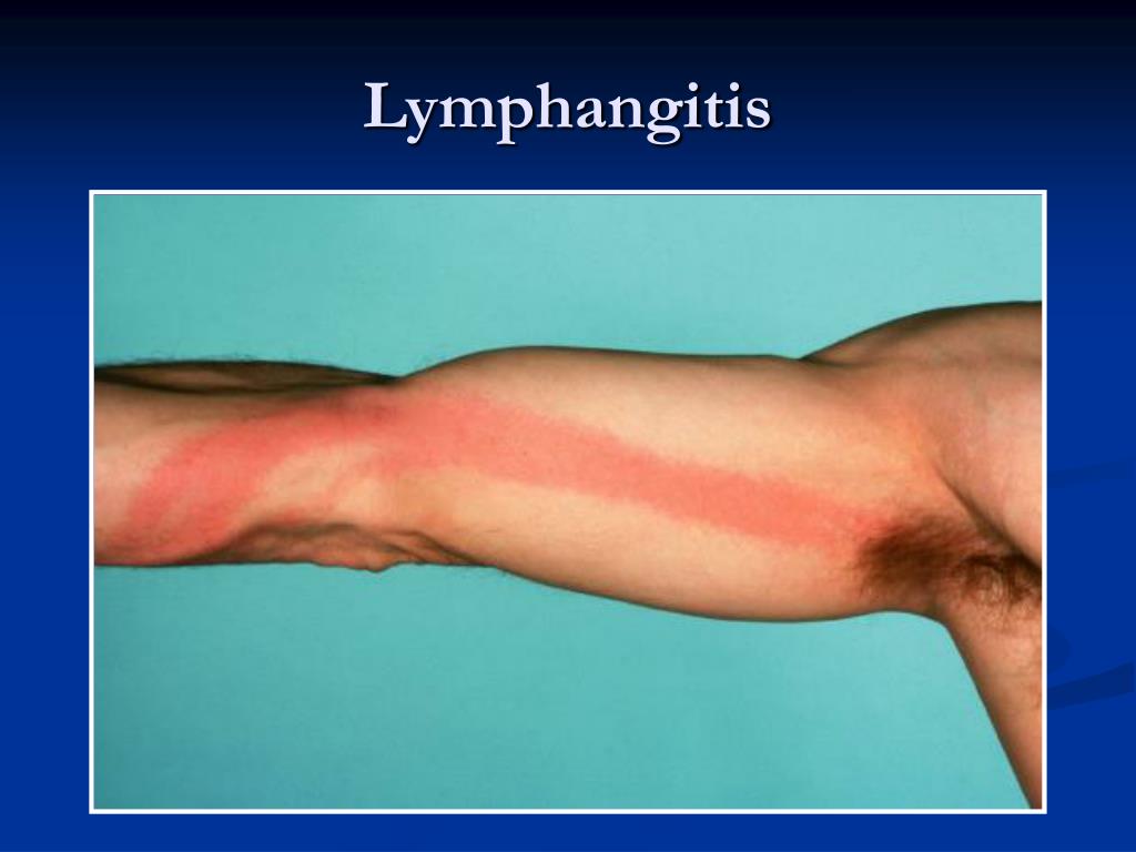 PPT Surgical Infection. Acute Purulent Infection of the Skin and