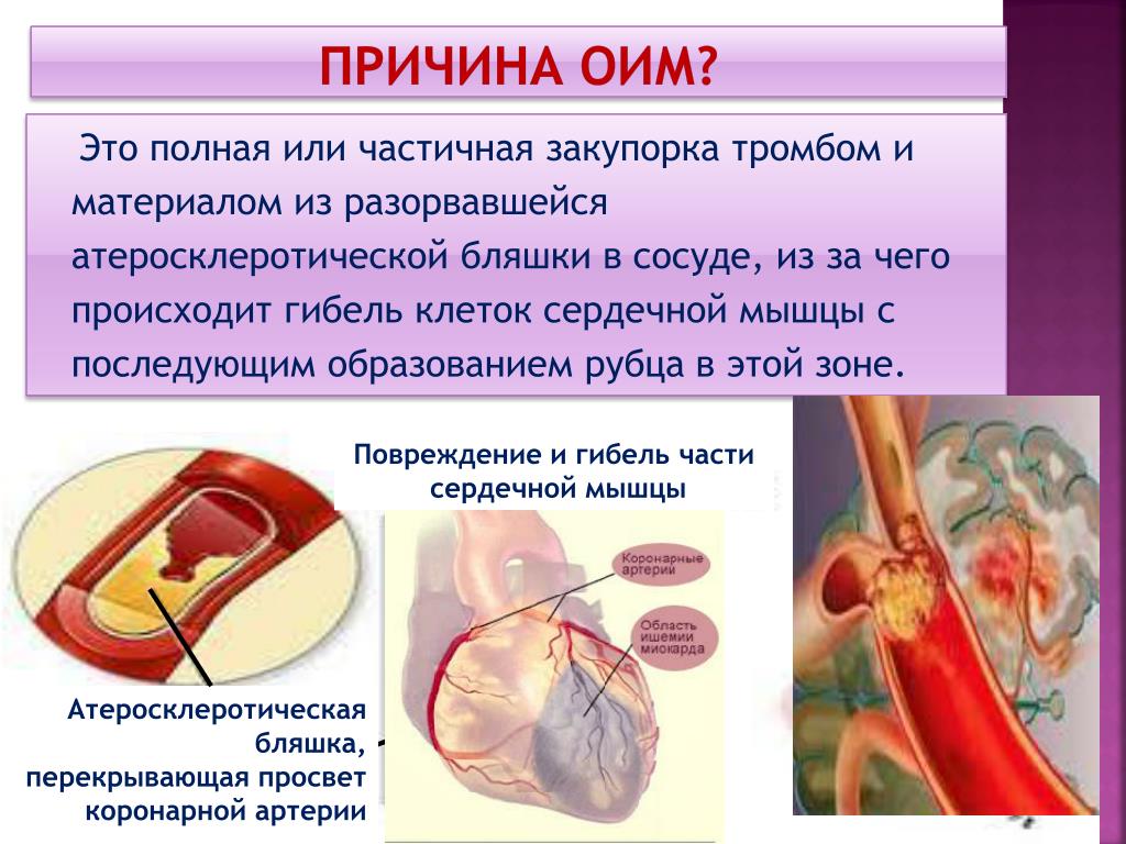 Презентация острый инфаркт миокарда