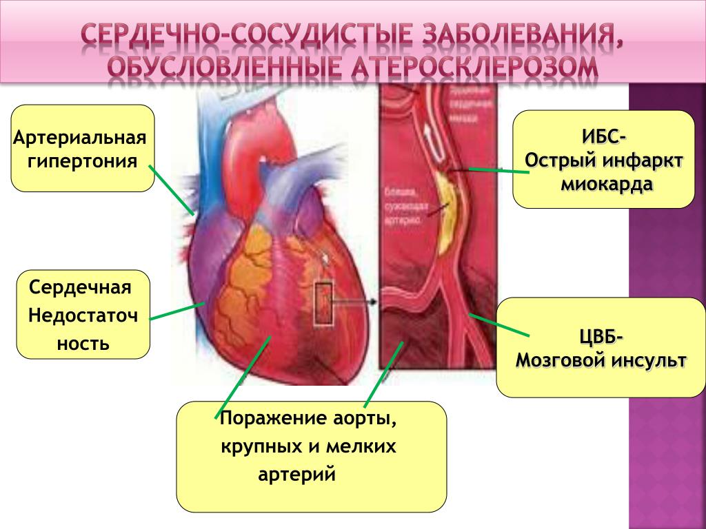 Какие есть сосудистые заболевания. Сердечно-сосудистые заболевания. Болезни сердечно-сосудистой системы. Нарушение сердечно сосудистой системы. Сердечно-сосудистые заболевания схема.