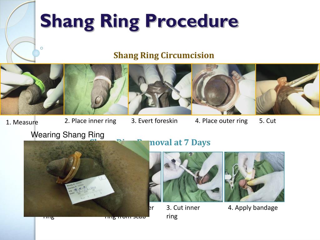 Ppt The Shang Ring Vs Conventional Surgical Techniques An Rct In Kenya And Zambia Powerpoint 5540