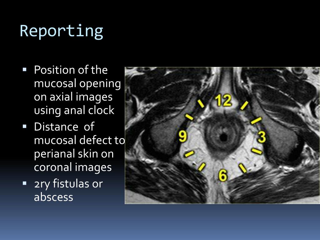 Mr Imaging Classification Of Perianal Fistulas And Its My Xxx Hot Girl 
