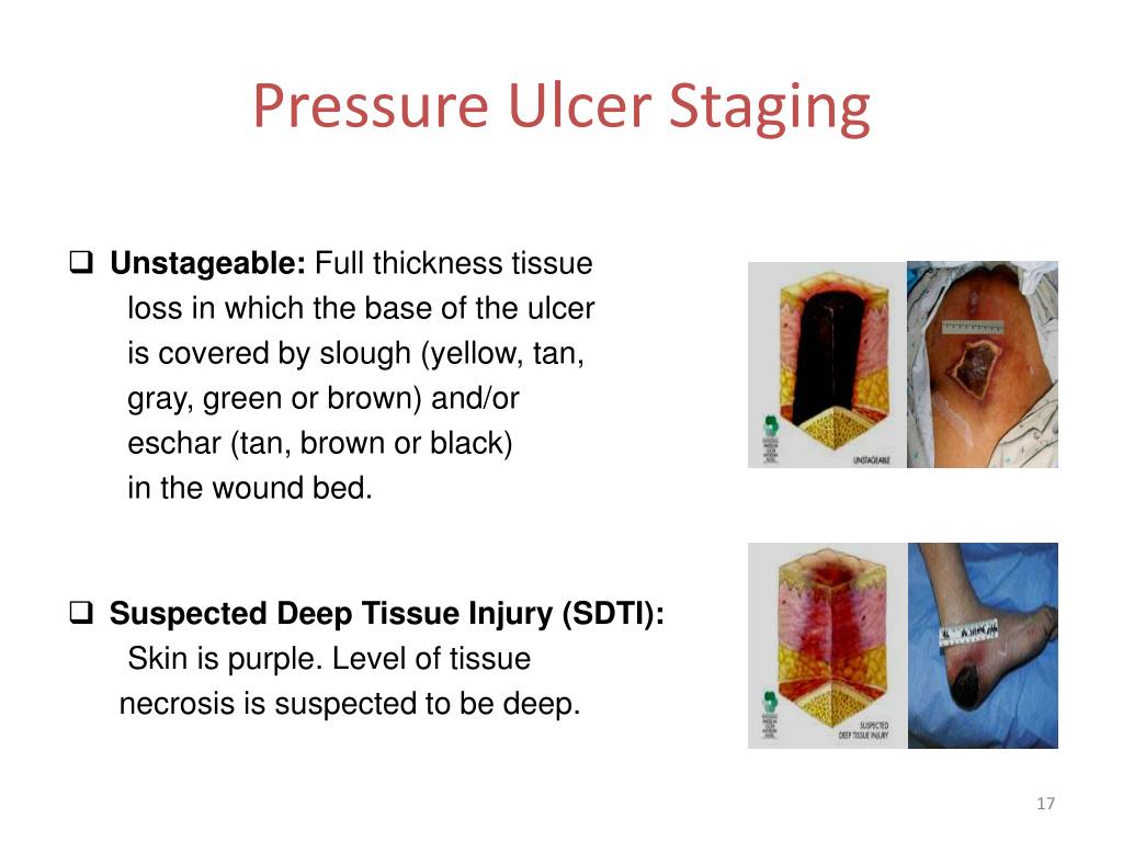 Pressure ulcer staging card - Stage 1: Intact skin with non- blanchable  redness of a localized area - Studocu