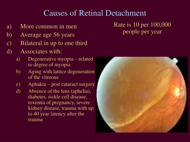 degenerative myopia bilateral degenerative myopia bilateral