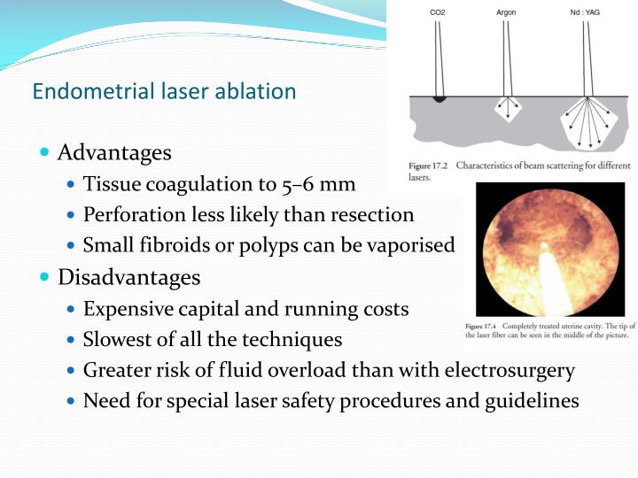 PPT Endometrial Ablation Techniques PowerPoint Presentation ID3007603