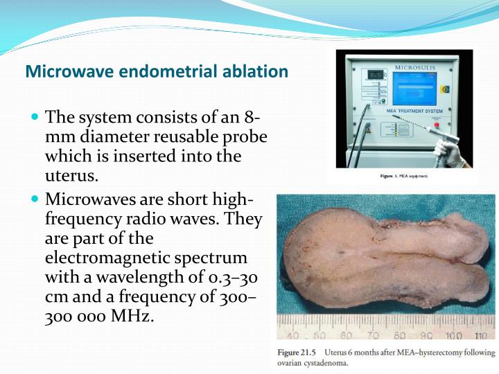 PPT - Endometrial Ablation Techniques PowerPoint Presentation - ID:3007603