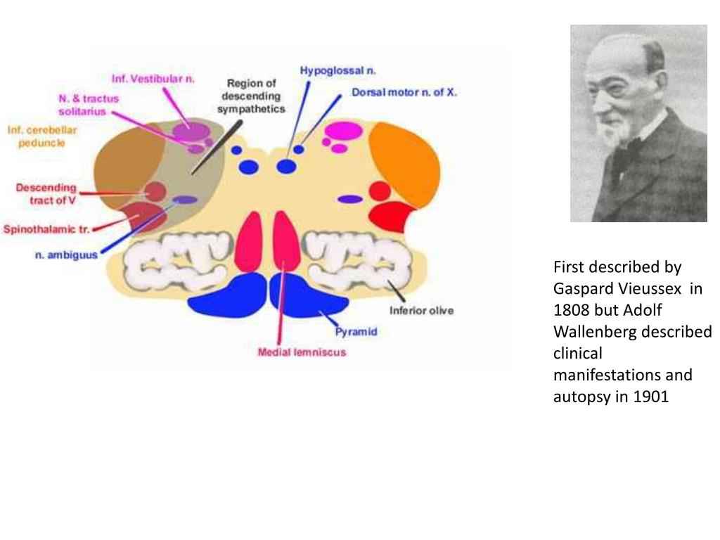 wallenberg syndrome powerpoint pica syndrome