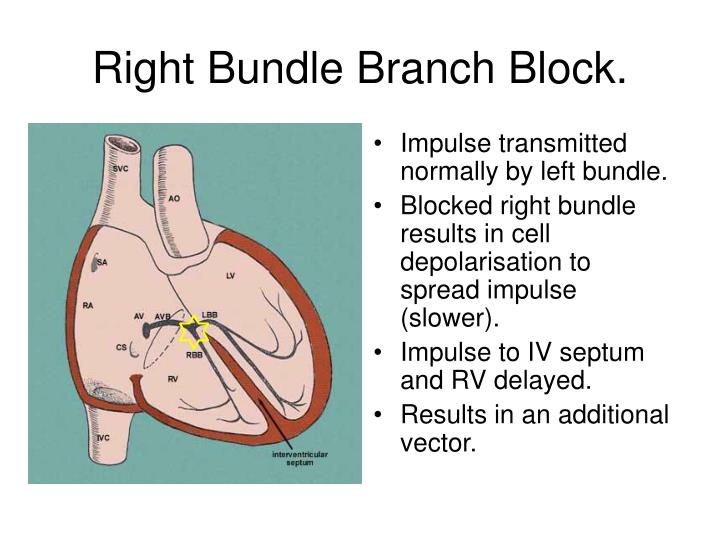 Right Versus Left Bundle Branch Block