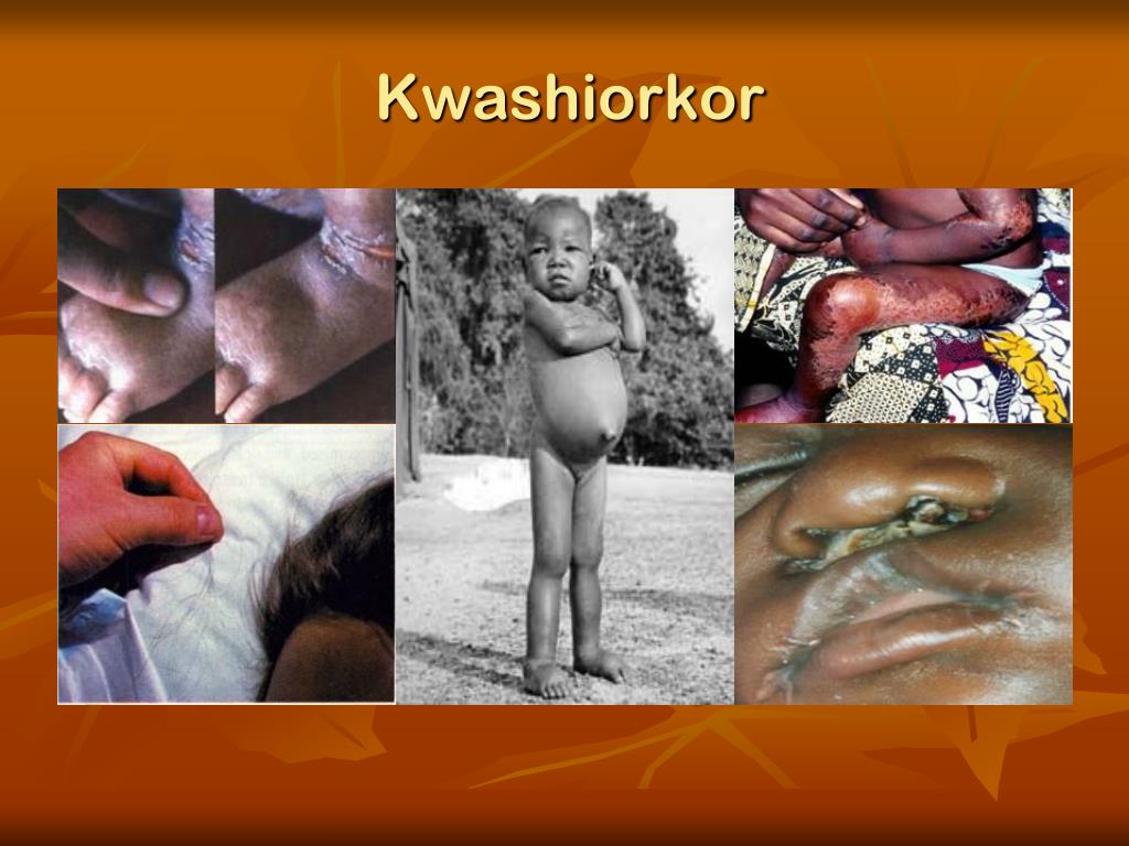 kwashiorkor case presentation slideshare