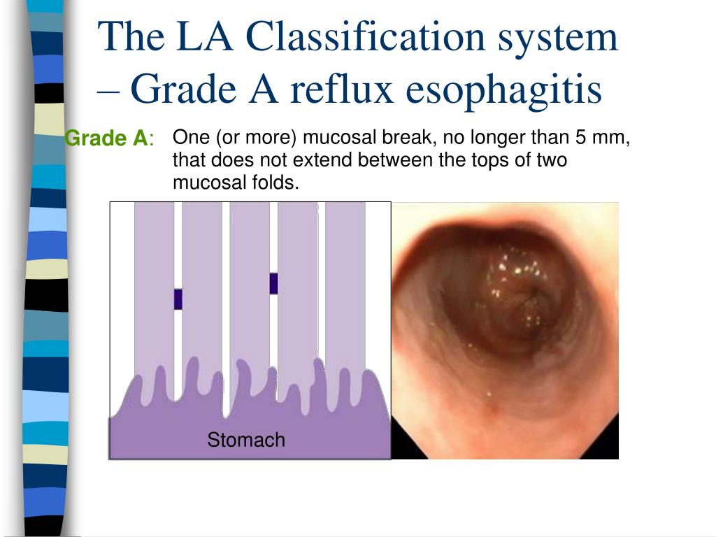 What Is La Grade A Reflux ACG Clinical Guideline Guidelines For The 