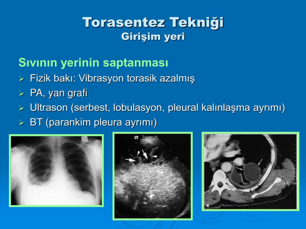 PPT Torasentez ve Değerlendirilmesi PowerPoint Presentation, free