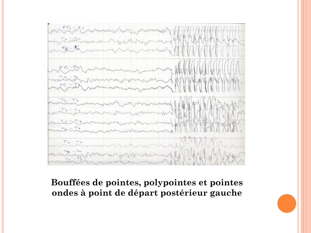 Polypoints Sample PPT - LA LEUCOENCEPHALOPATHIE MEGALENCEPHALIQUE AVEC KYSTES A PROPOS D ...