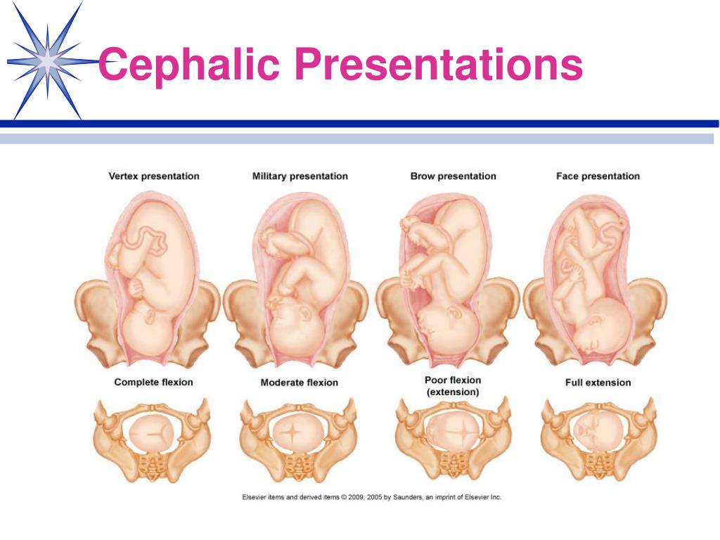 cephalic presentation mean labor is coming