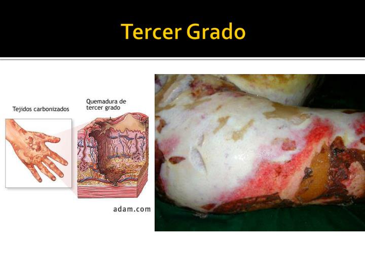 PPT - Quemaduras PowerPoint Presentation - ID:3037960 PPT - Quemaduras PowerPoint Presentation - ID:3037960