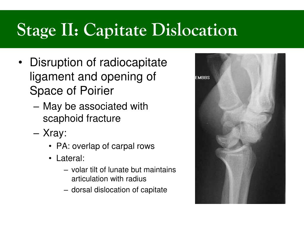 PPT - Xray Rounds: Carpal Instabilities Heather Patterson PGY 2 ...
