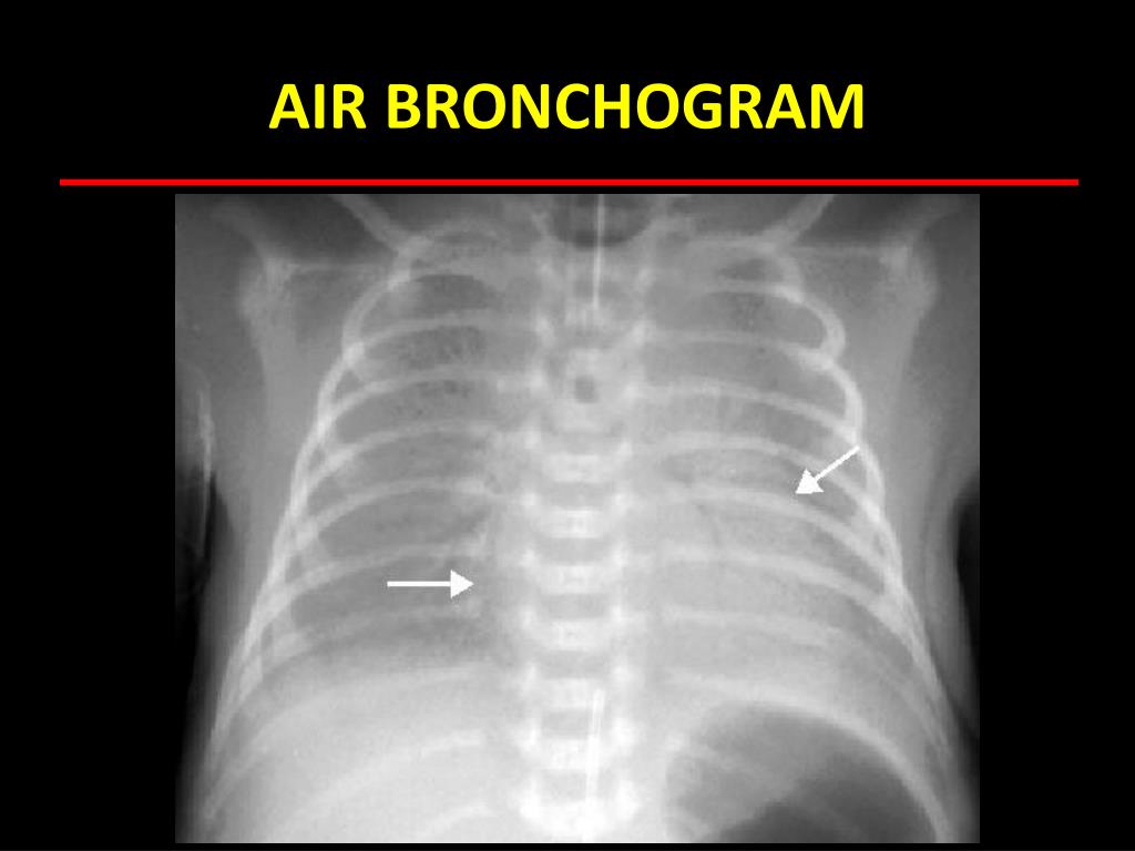 Air Bronchogram IKPUUB