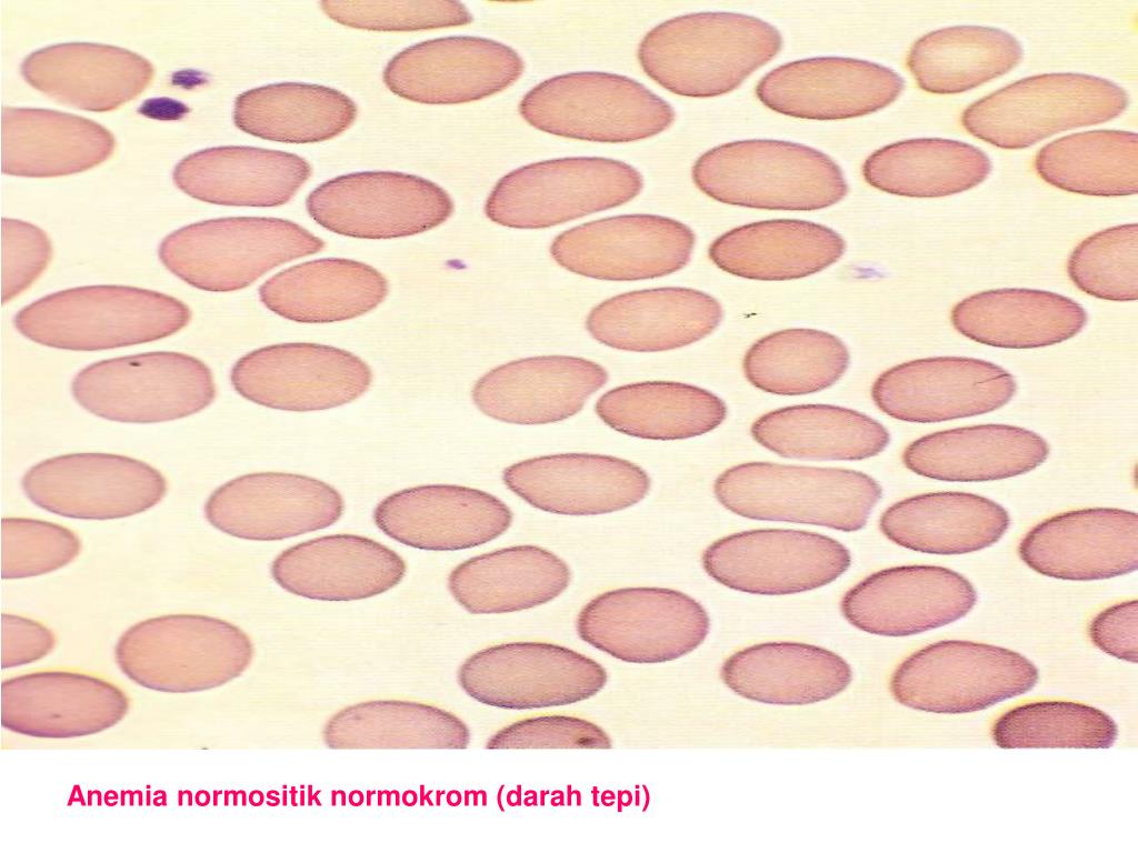 Gambaran Darah Tepi Anemia Hemolitik PPT - PEMERIKSAAN LABORATORIUM PADA ANEMIA HEMOLITIK PowerPoint