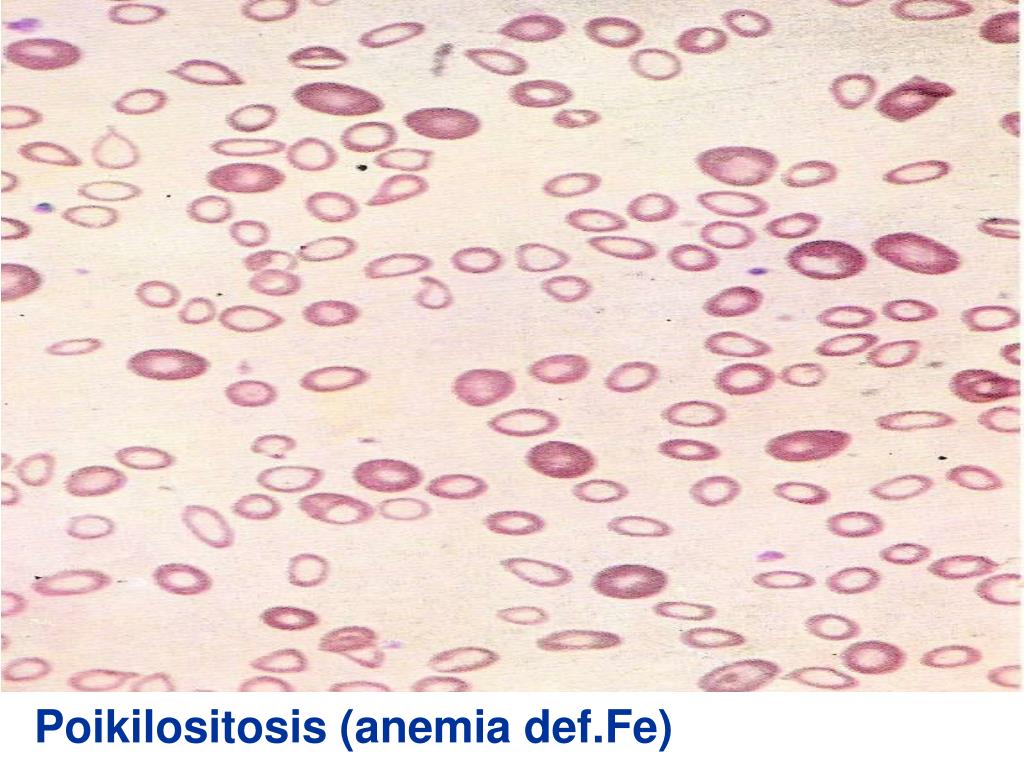 Gambaran Darah Tepi Anemia Hemolitik PPT - PEMERIKSAAN LABORATORIUM PADA ANEMIA HEMOLITIK PowerPoint