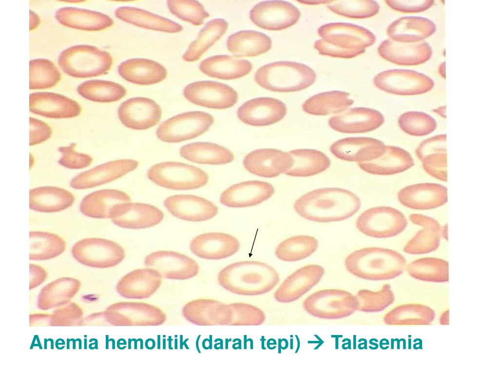 Gambaran Darah Tepi Anemia Hemolitik Gambaran Darah Tepi Anemia Hemolitik