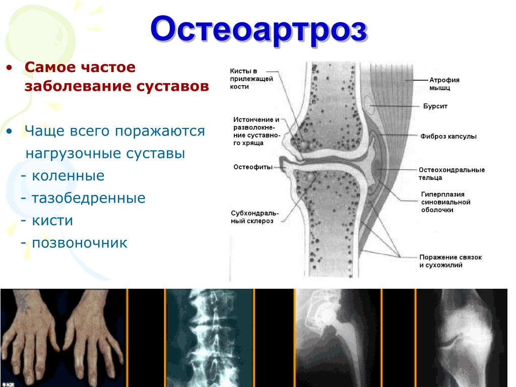 Лечение остеоартроза презентация