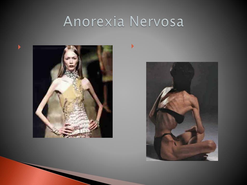 anorexia nervosa scholarly articles