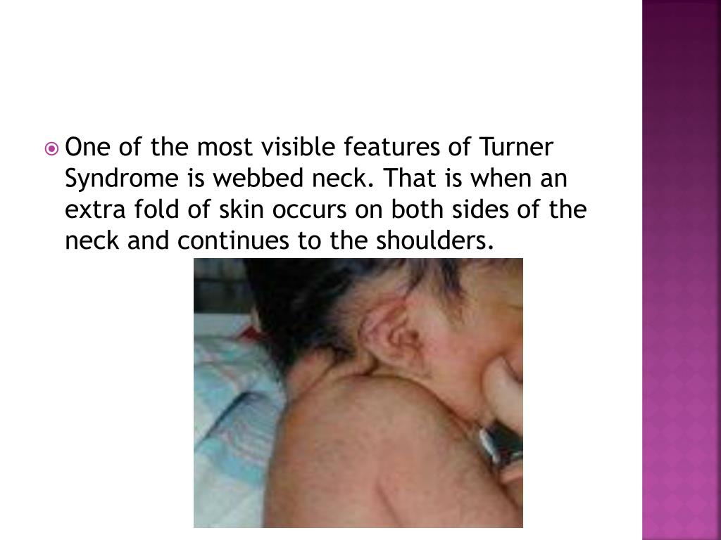 Ppt Turner Syndrome Powerpoint Presentation Free Download Id3066020