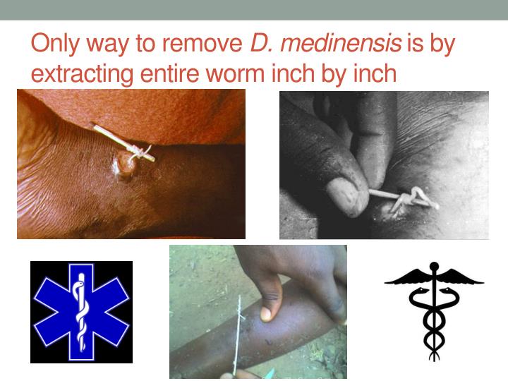 only-way-to-remove-d-medinensis-is-by-ex