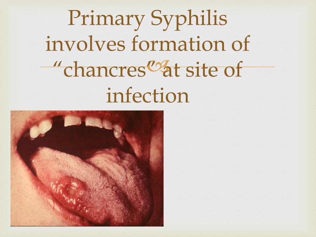 clinical presentation of primary syphilis