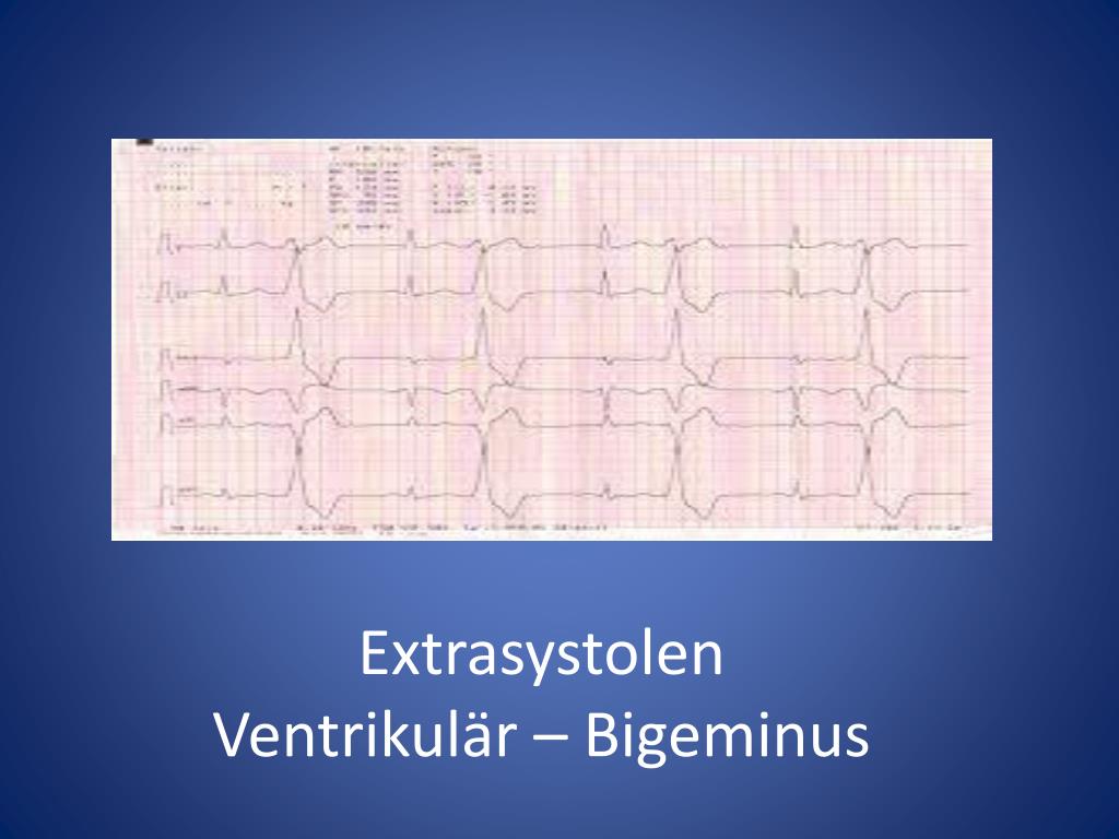 PPT - Herzlich Willkommen! zu: EKG verstehen und bewerten PowerPoint