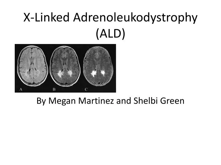 x linked adrenoleukodystrophy x linked adrenoleukodystrophy