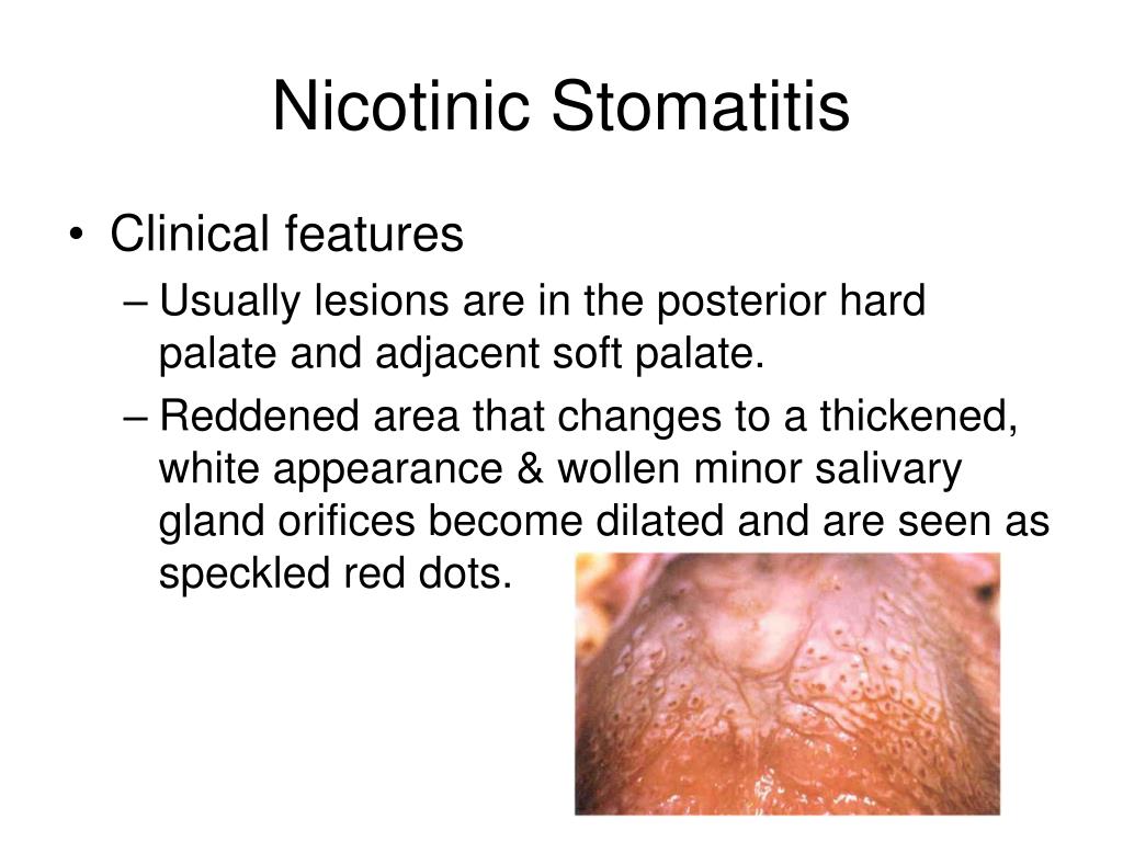 PPT Tobacco Related Lesions Oral Medicine Block PowerPoint