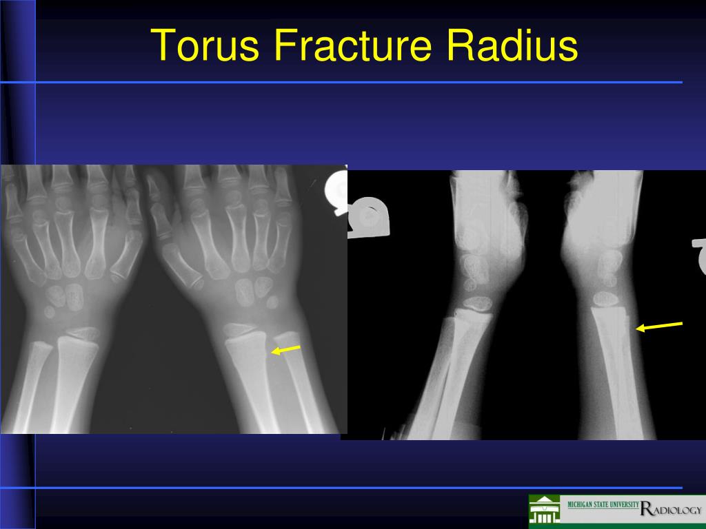 distal radius torus fracture treatment