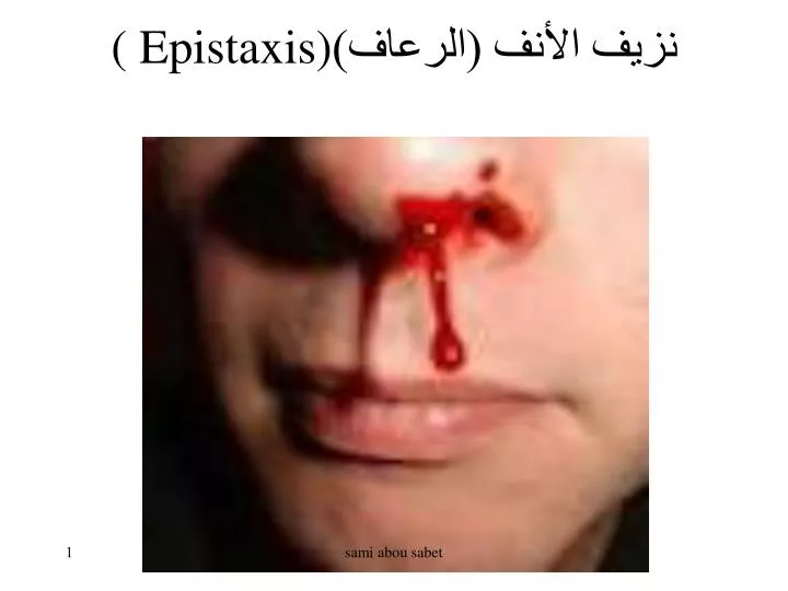PPT نزيف الأنف (الرعاف) ( Epistaxis) PowerPoint