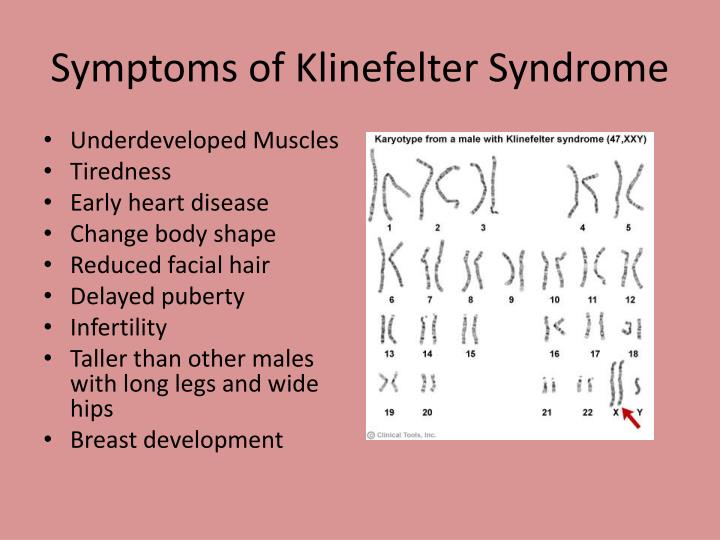 Ppt Klinefelter Syndrome Powerpoint Presentation Id