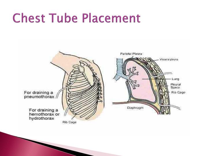 PPT Chest Tubes PowerPoint Presentation ID3090007
