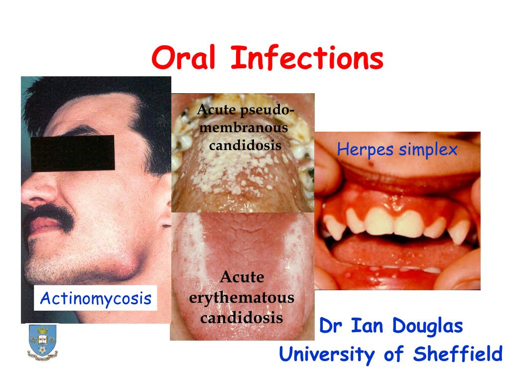 PPT - Oral Infections PowerPoint Presentation, free download - ID:3094360