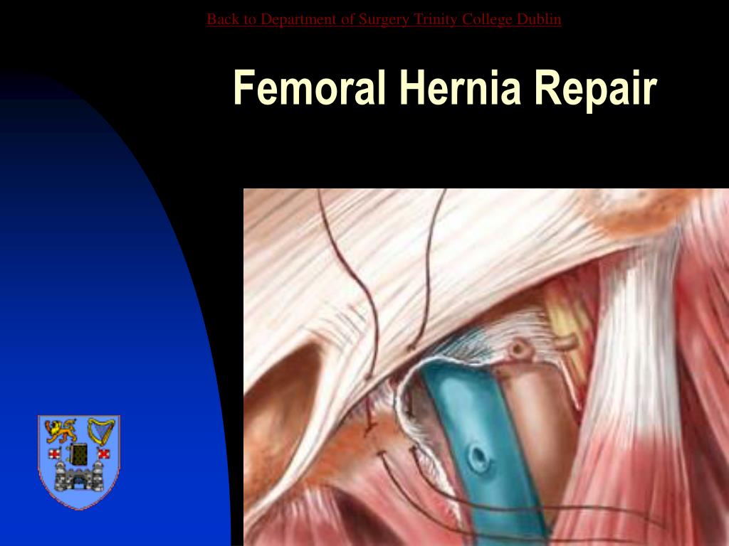 PPT - Abdominal Wall Hernia PowerPoint Presentation, free download - ID ...