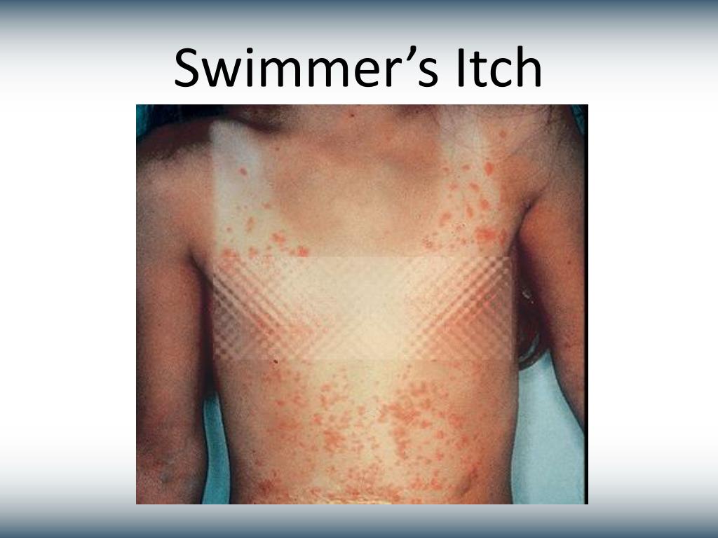 swimmers itch rash pictures
