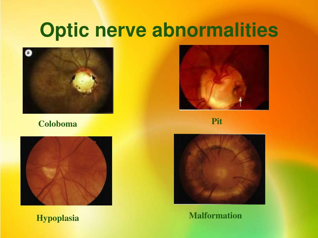 PPT The Congenital Developmental Glaucomas PowerPoint Presentation 